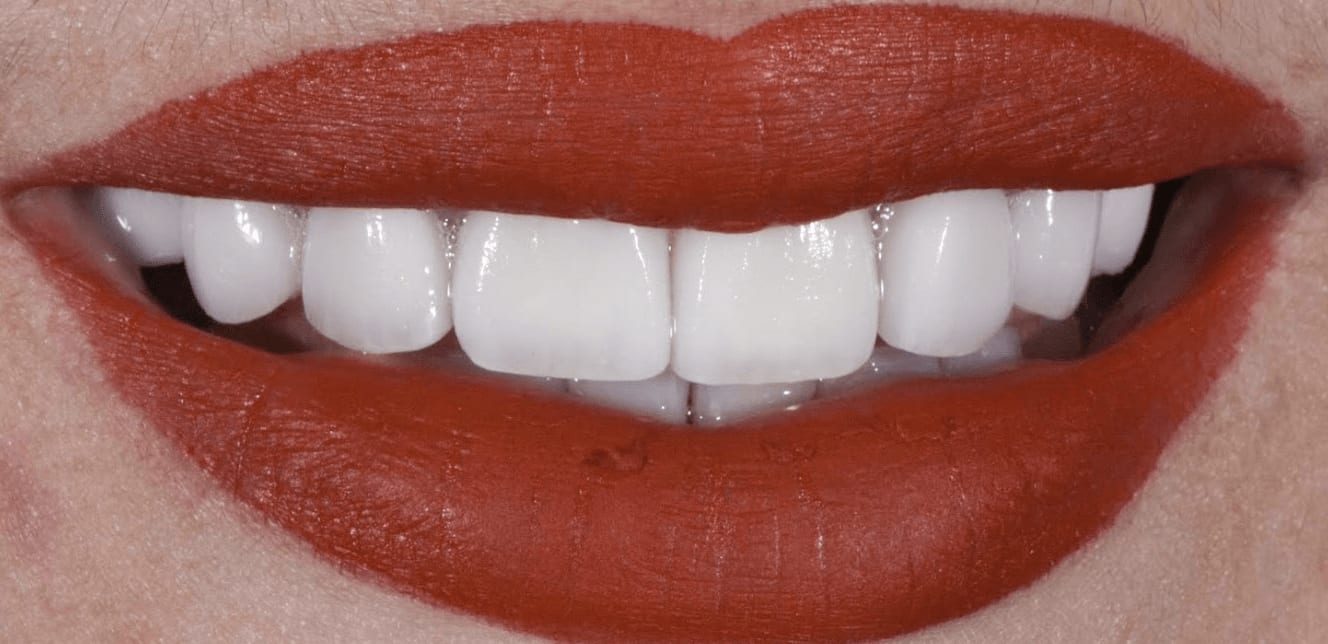 Dental Veneers After, Female 24 - 227