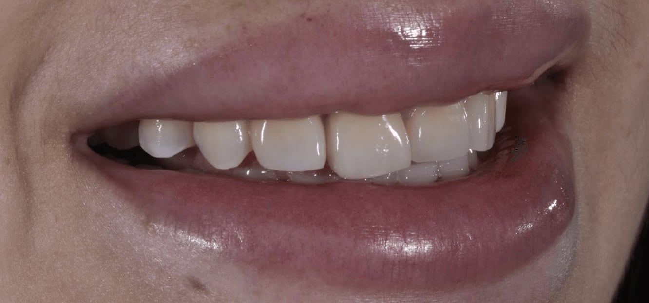 Dental Veneers Before, Female 26 - 228