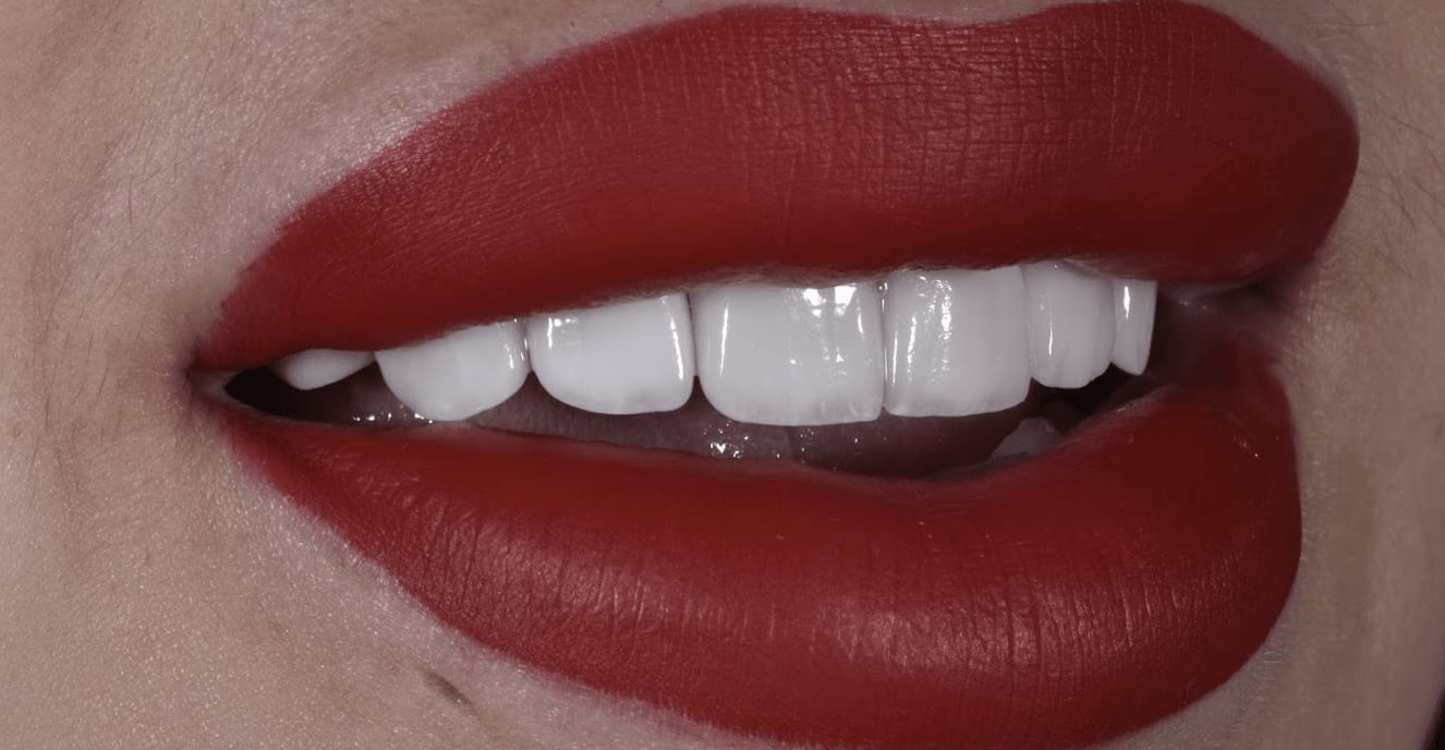 Dental Veneers After, Female 26 - 228