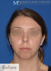 Chin Enhancement Solutions Before, Female 34 - 1851