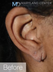 Earlobe Restoration Solutions Before, Female 27 - 1852