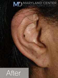 Earlobe Restoration Solutions After, Female 27 - 1852