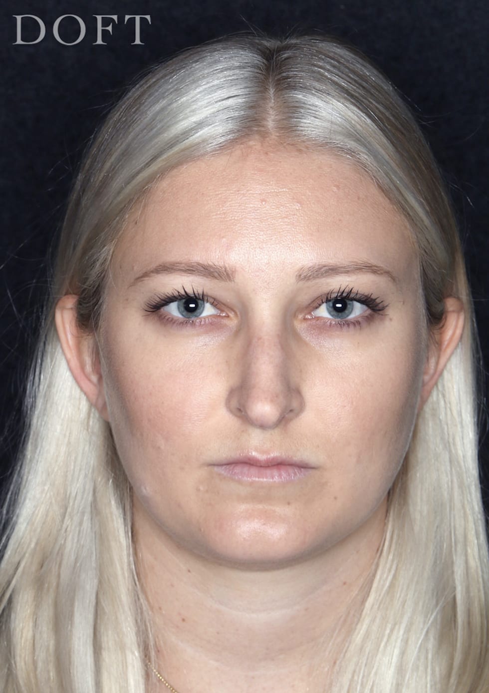Rhinoplasty Before, Female 26 - 282