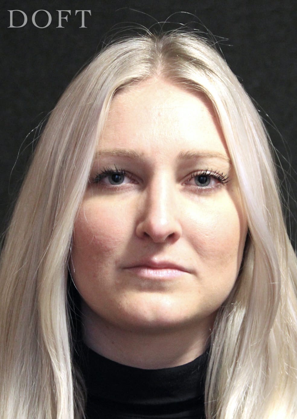 Rhinoplasty After, Female 26 - 282