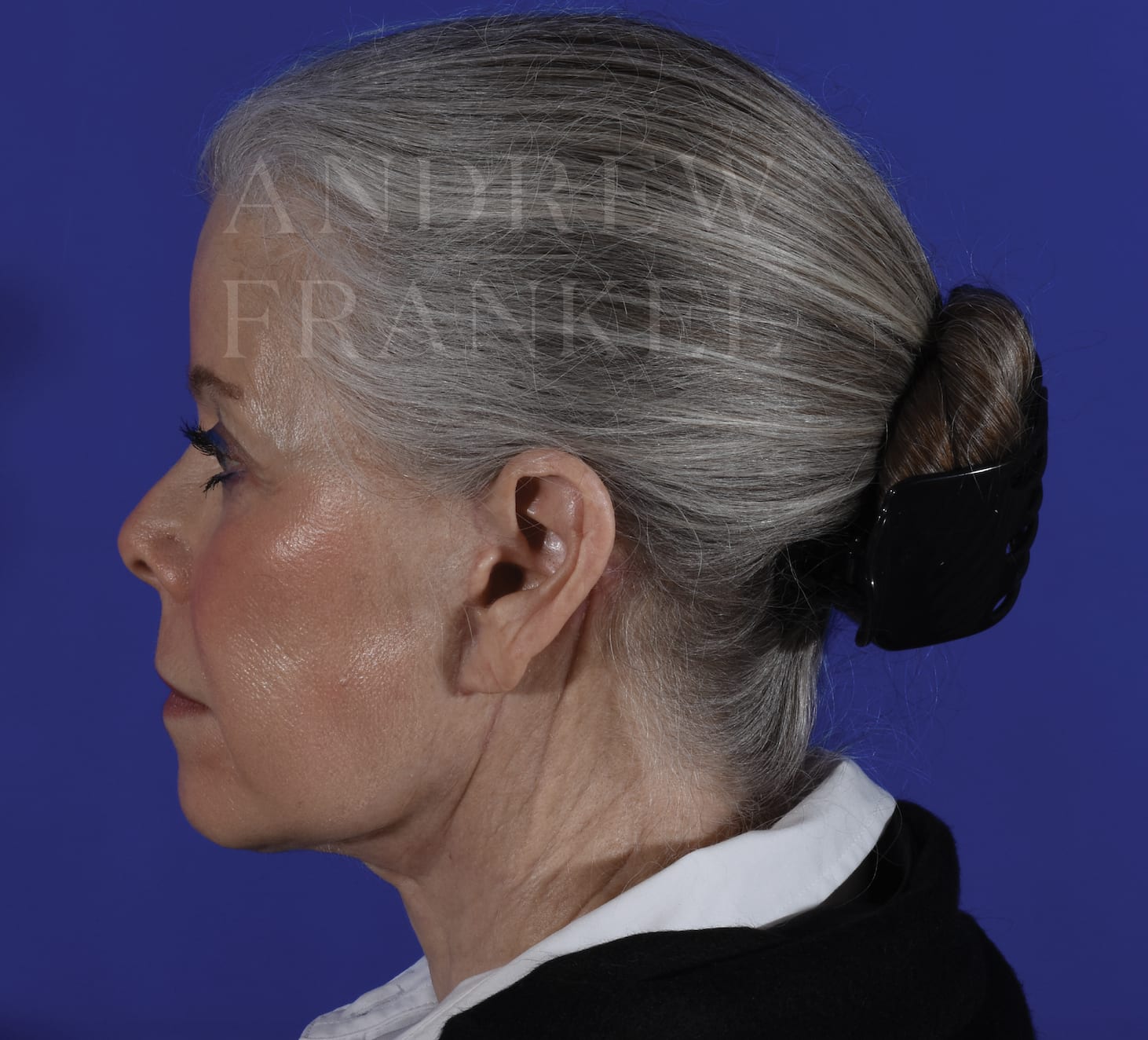 Deep Plane Facelift After, Female 66 - 307