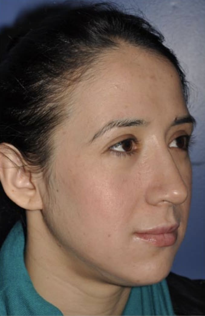 Rhinoplasty After, Female 34 - 323