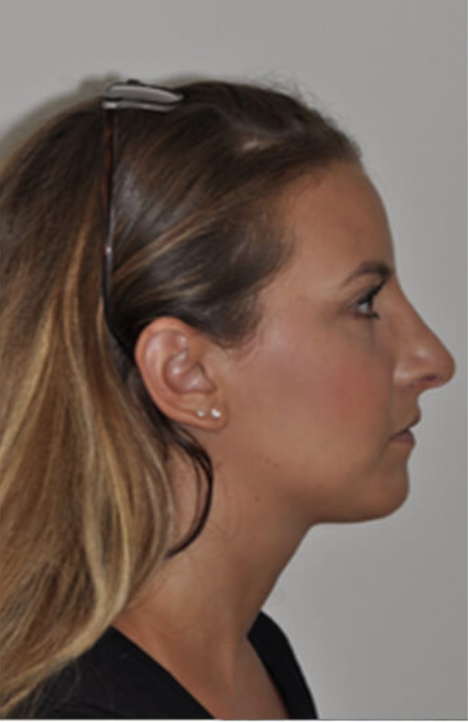 Rhinoplasty After, Female 25 - 324