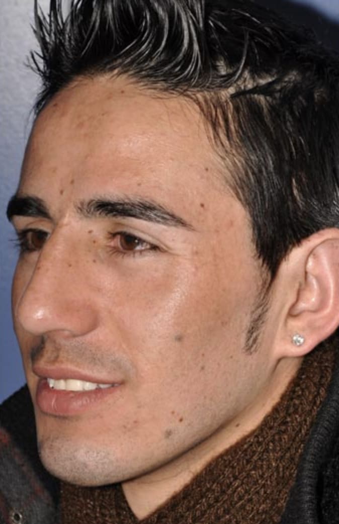 Rhinoplasty After, Male 27 - 325