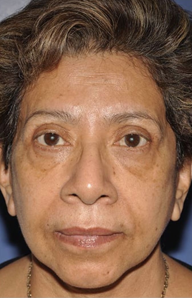 Facelift After, Female 68 - 327