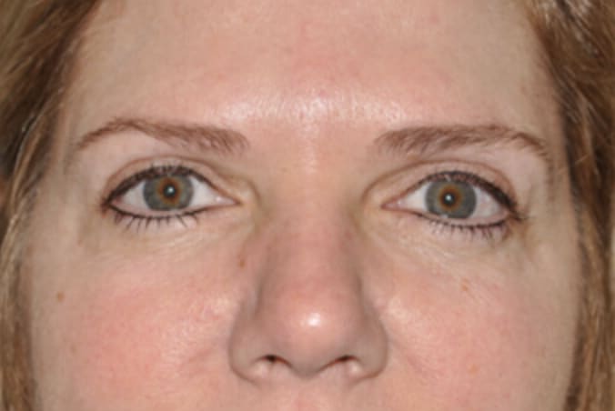 Blepharoplasty After, Female 43 - 329