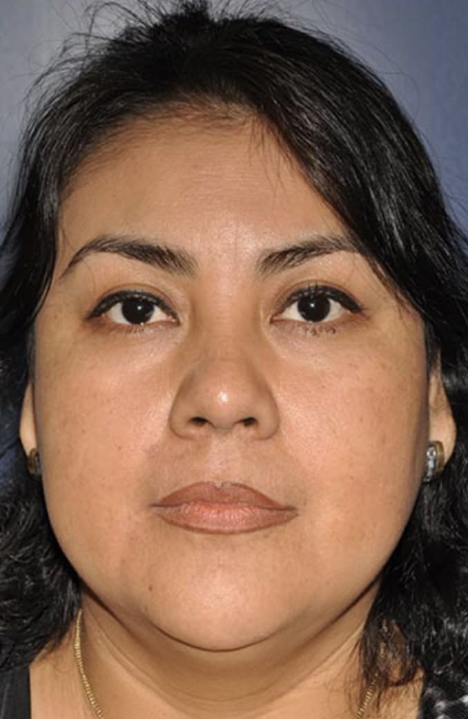 Buccal Fat Removal Before, Female 31 - 330