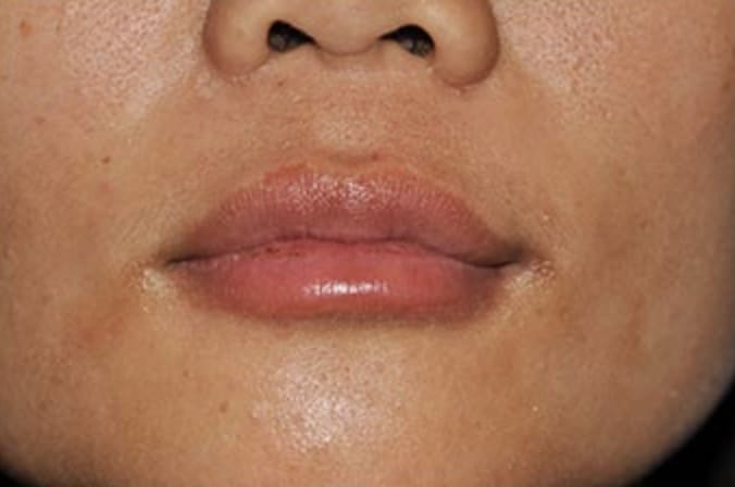 Lip Augmentation and Injections After, Female 32 - 331