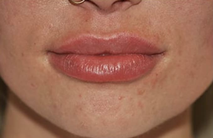 Lip Augmentation and Injections After, Female 24 - 332