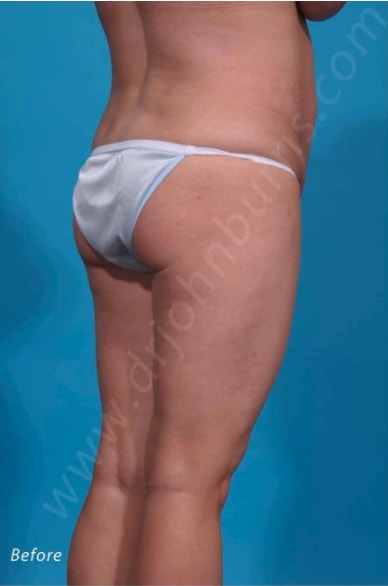 Brazilian Butt Lift Before, Female 37 - 475