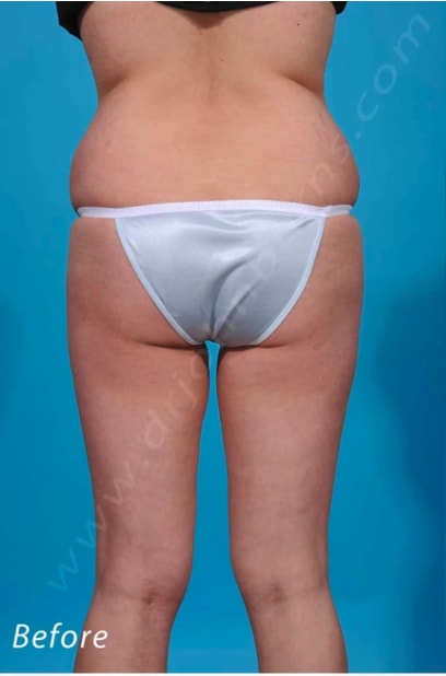 Brazilian Butt Lift Before, Female 33 - 476