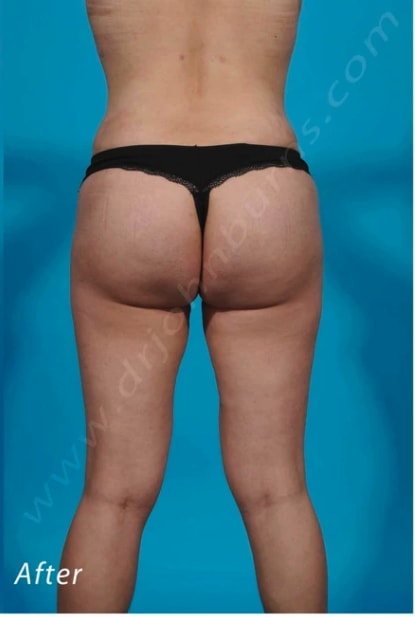 Brazilian Butt Lift After, Female 33 - 476
