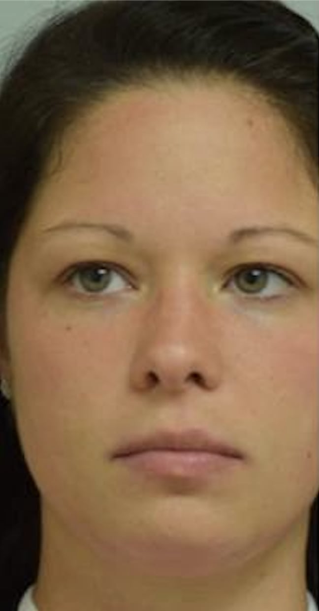 Invisalign® Before, Female 27 - 497