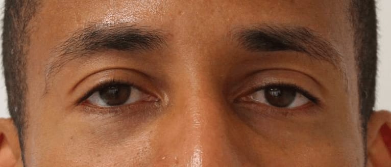 Under Eye Filler Before, Male 34 - 537