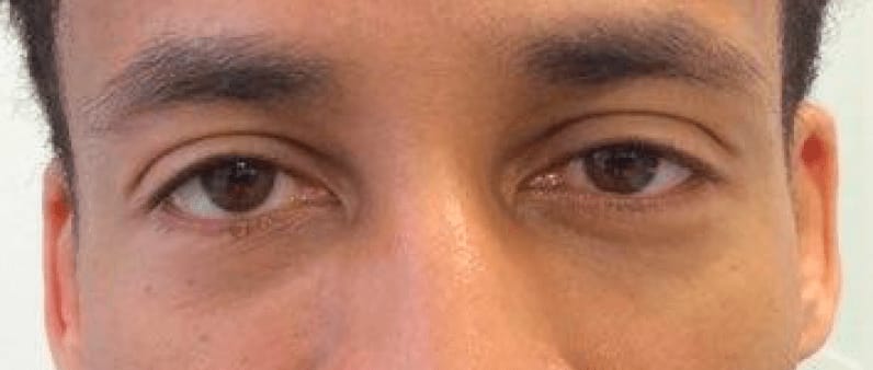 Under Eye Filler After, Male 34 - 537