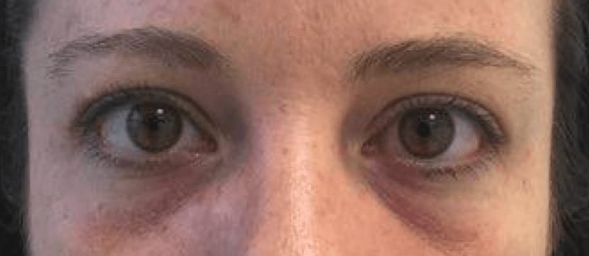Under Eye Filler Before, Female 28 - 535
