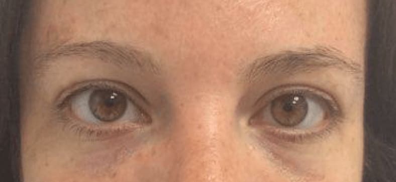 Under Eye Filler After, Female 28 - 535