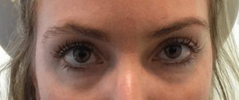 Under Eye Filler Before, Female 35 - 536