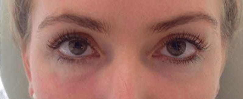 Under Eye Filler After, Female 35 - 536