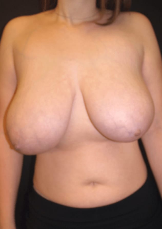 Breast Reduction Before, Female 29 - 571