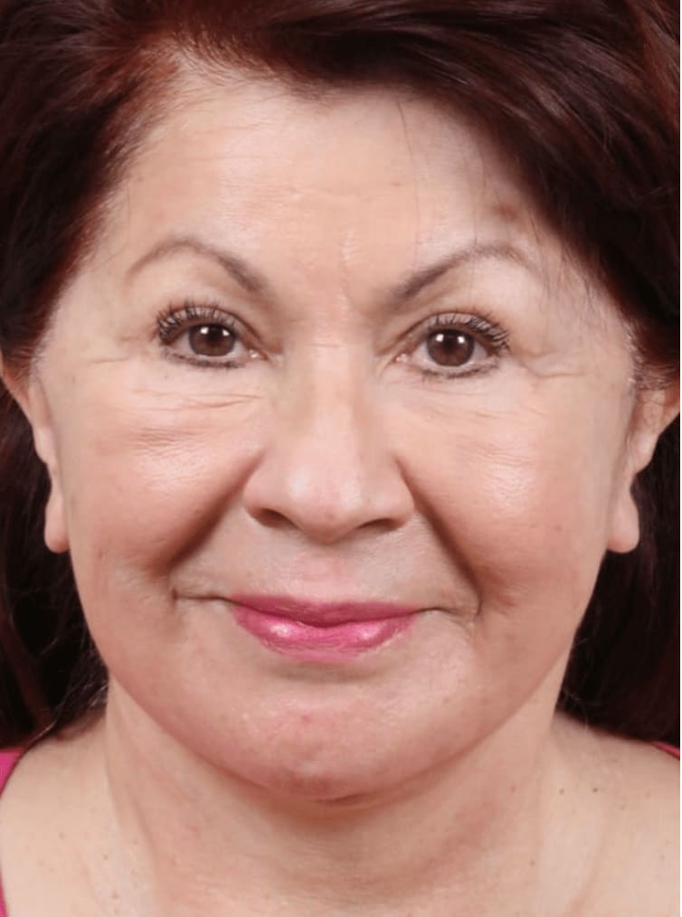 Facelift After, Female 65 - 593