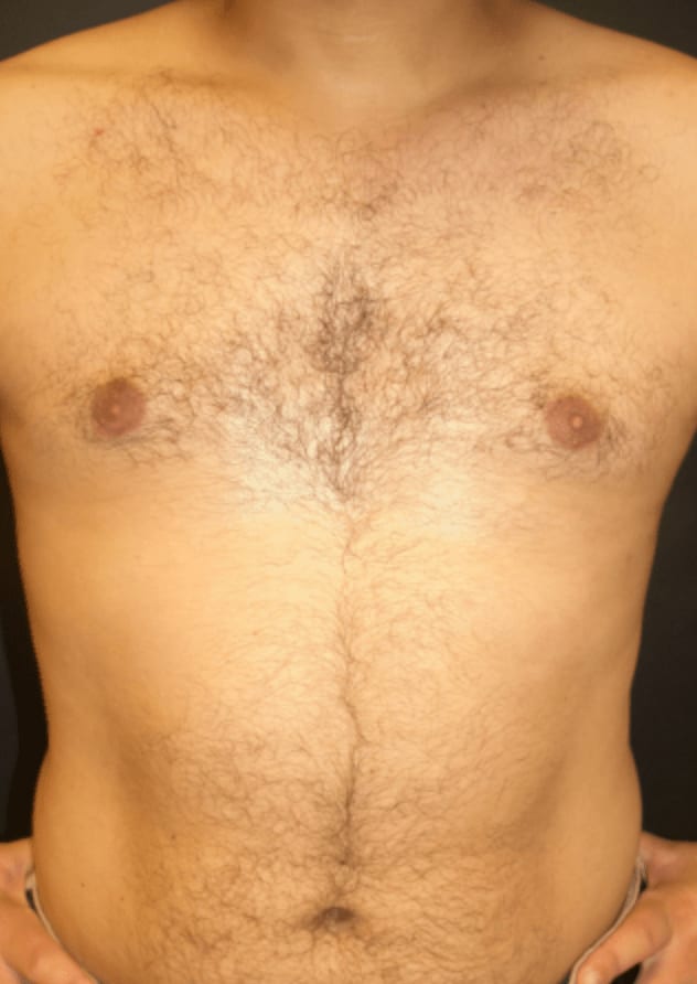 Male Breast Reduction (Gynecomastia Surgery) After, Male 32 - 594