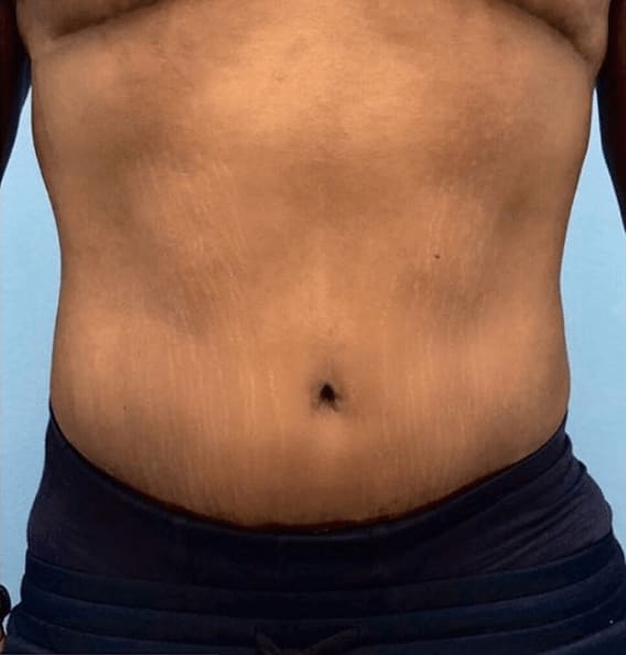 Tummy Tuck (Abdominoplasty) After, Male 34 - 601