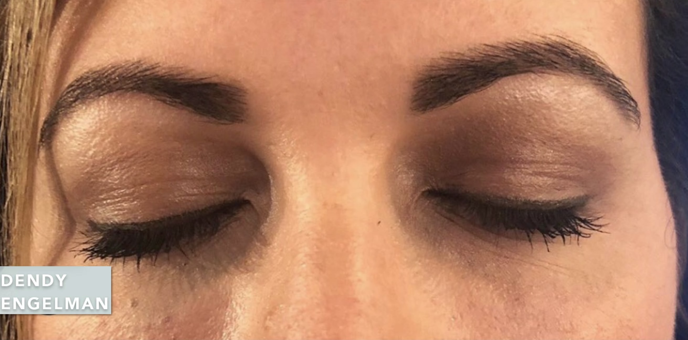 Intense Pulsed Light After, Female 35 - 636