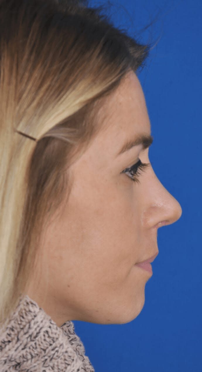 Revision Rhinoplasty After, Female 28 - 662