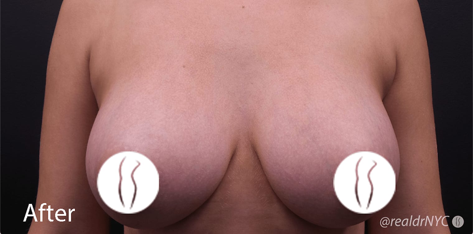 Breast Augmentation with Implants After, Female 21 - 705