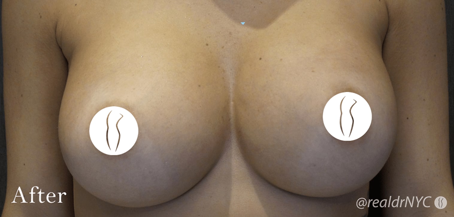 Breast Augmentation with Implants After, Female 24 - 707
