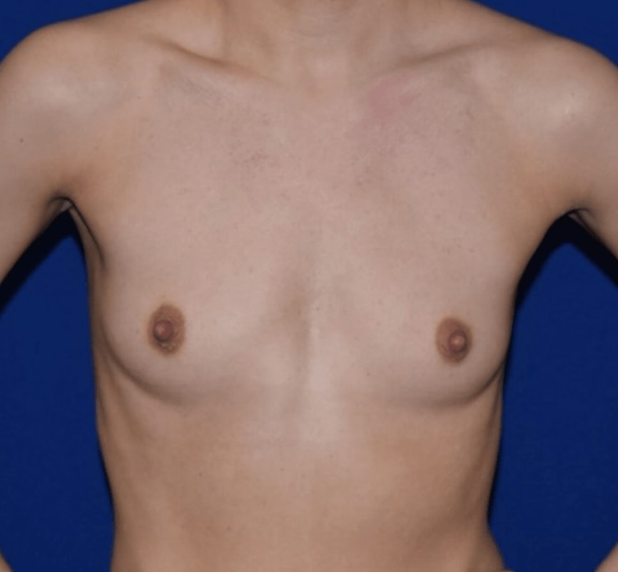 Breast Augmentation (Augmentation Mammaplasty) Before, Female 32 - 741