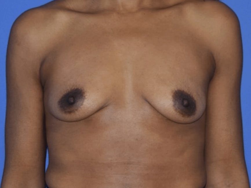 Breast Augmentation (Augmentation Mammaplasty) Before, Female 42 - 745