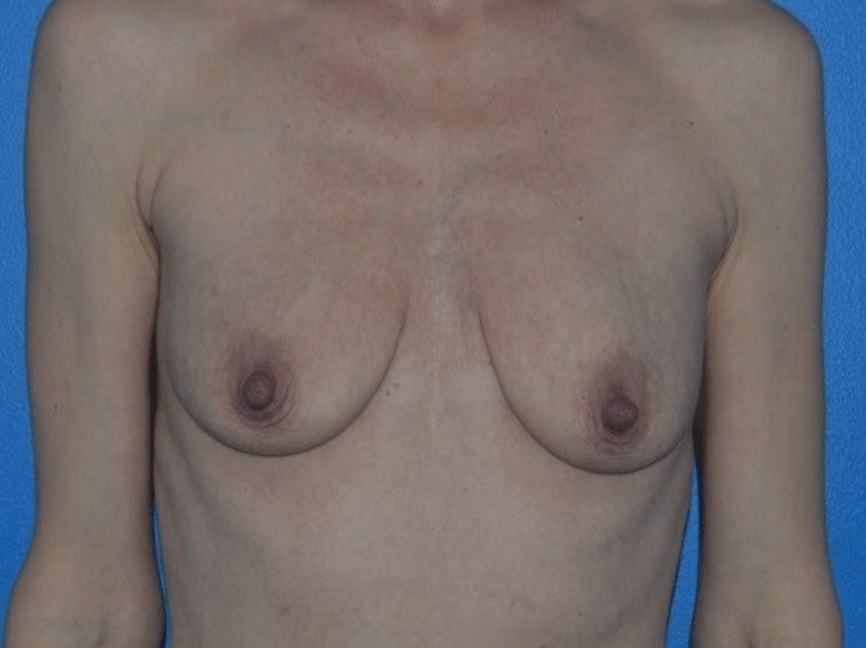 Breast Augmentation (Augmentation Mammaplasty) Before, Female 50 - 746