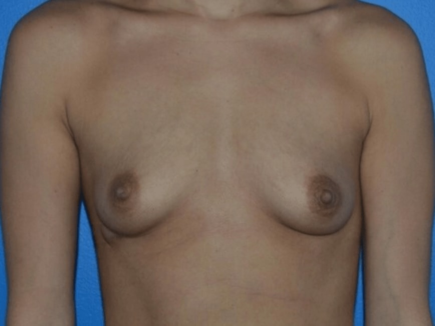 Breast Augmentation (Augmentation Mammaplasty) Before, Female 20 - 747