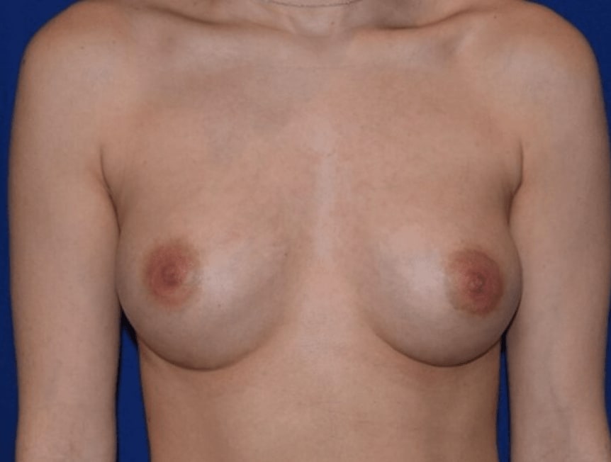 Breast Augmentation (Augmentation Mammaplasty) After, Female 20 - 747