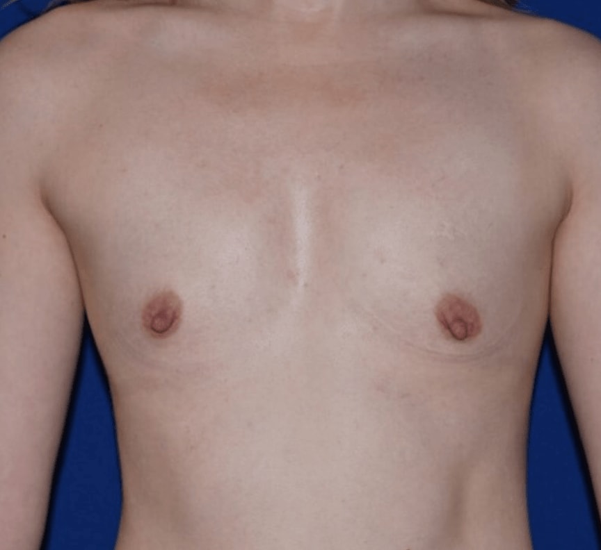 Breast Augmentation (Augmentation Mammaplasty) Before, Female 24 - 748