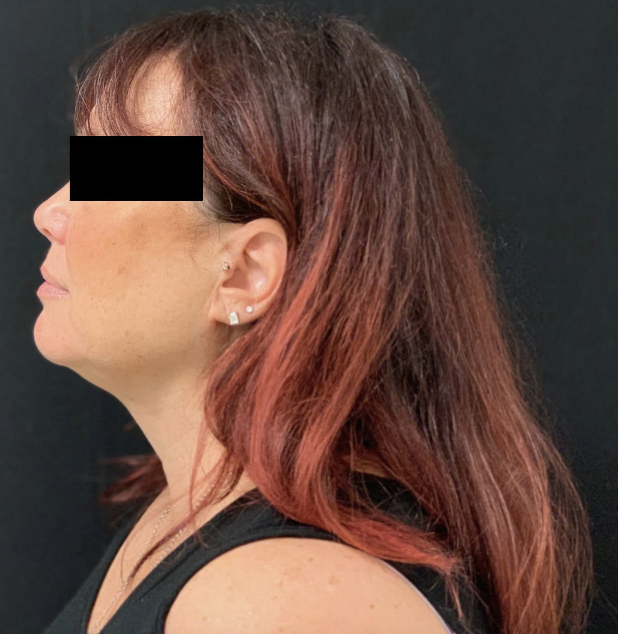 Liposuction After, Female 32 - 759