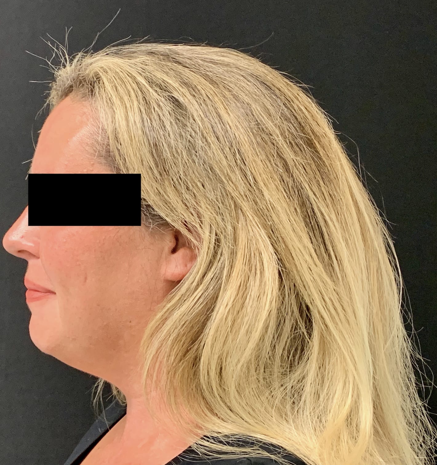 Liposuction Before, Female 37 - 761