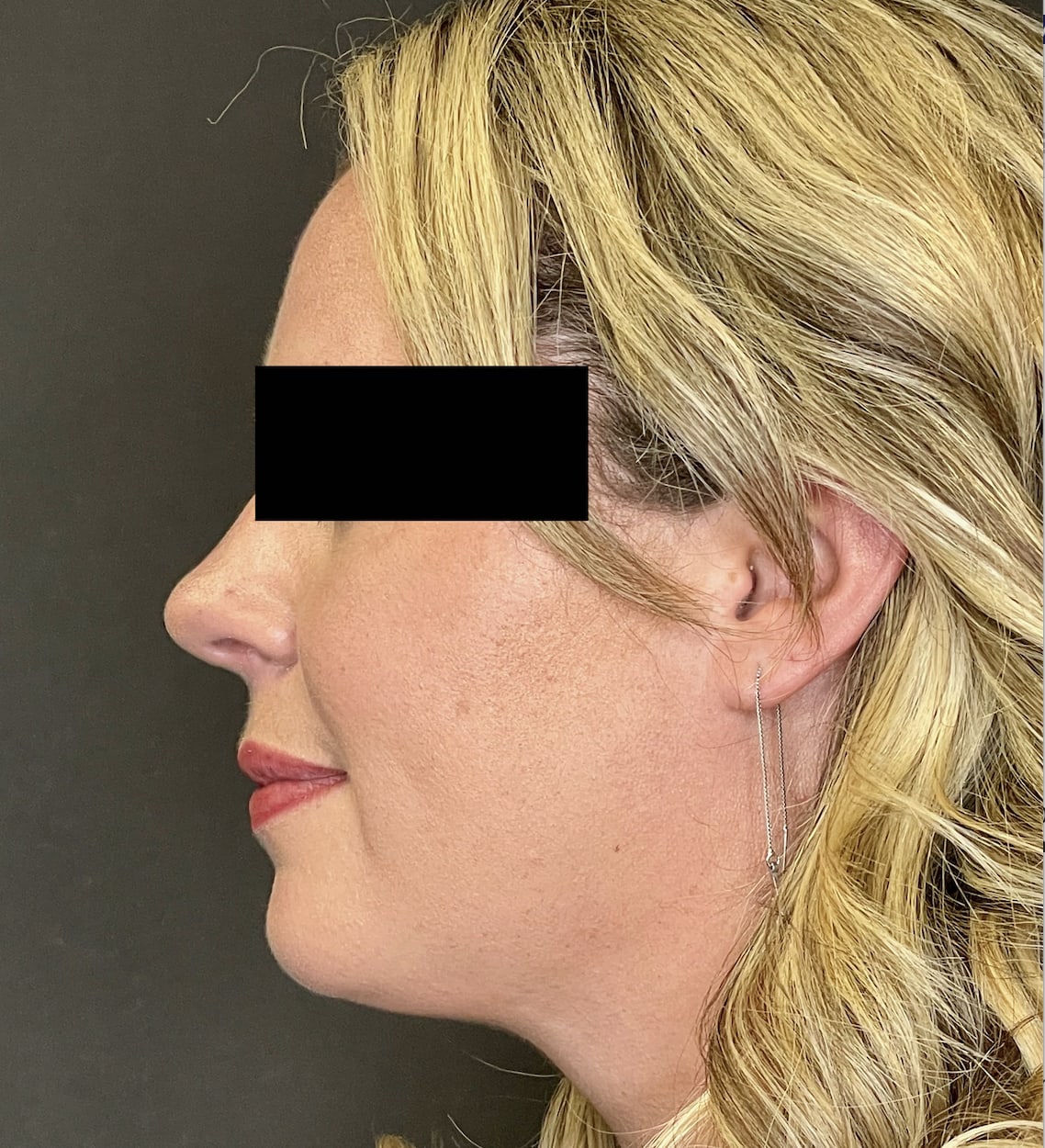 Liposuction After, Female 37 - 761