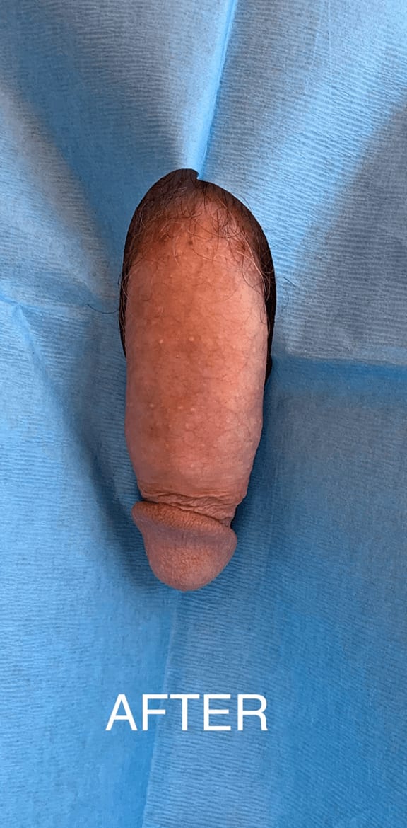 Penis Enlargement: Dermal Fillers After, Male 32 - 793