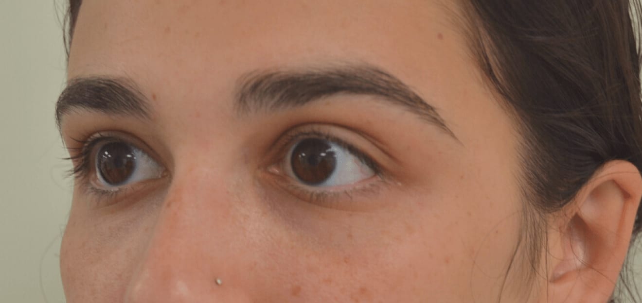 Under Eye Filler After, Female 32 - 808