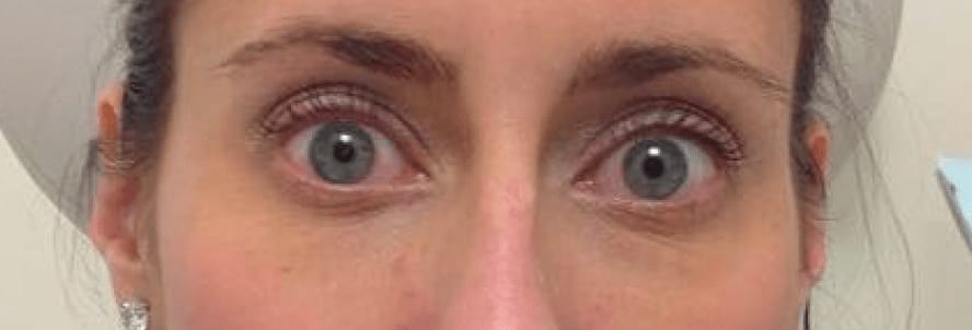 Under Eye Filler After, Female 32 - 807