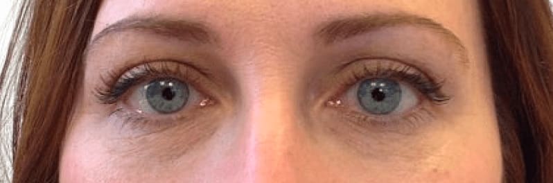 Under Eye Filler After, Female 31 - 812