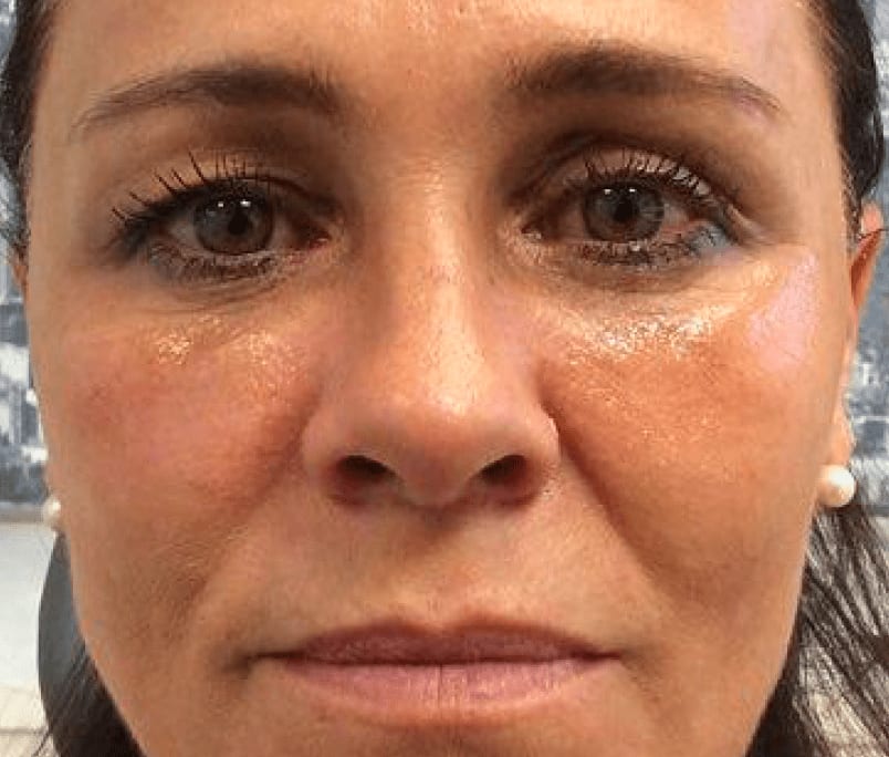 Under Eye Filler After, Female 48 - 811