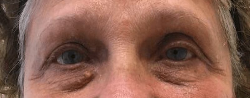 Under Eye Filler Before, Female 65 - 810